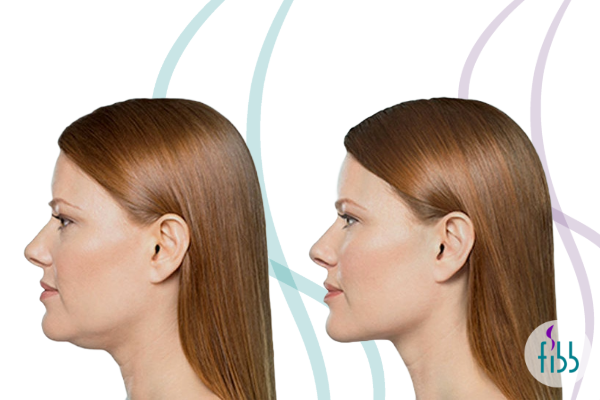 Before and after female patient