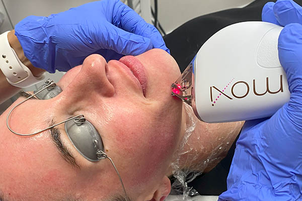 Moxi laser treatment performed on woman at FIBB