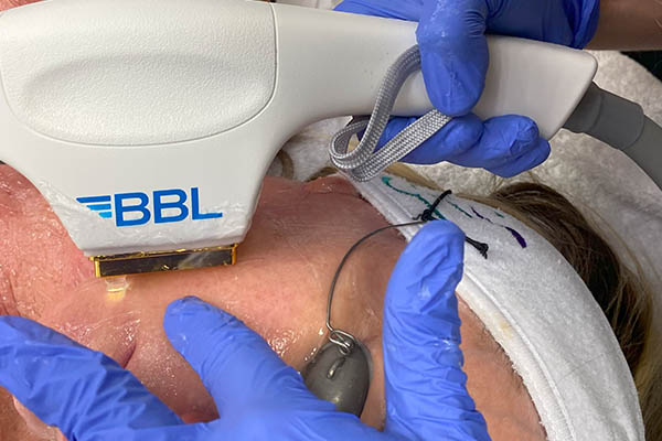 BBL Hero Treatment On Patients Face at FIBB
