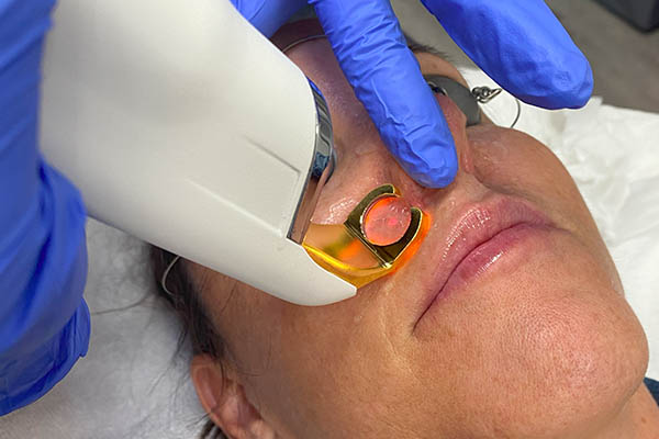 ClearV treatment on patient facial area