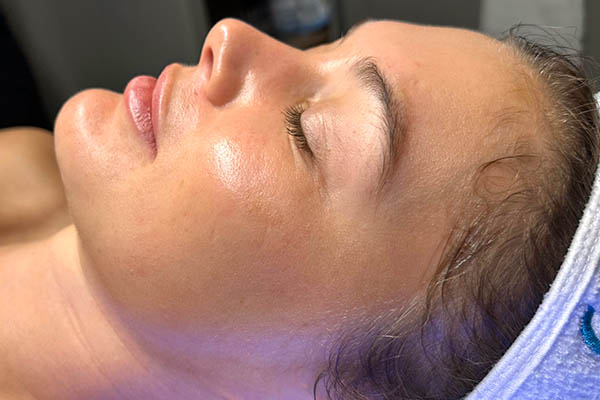 Patient post hydrafacial