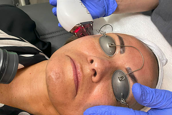 MOXI laser skin treatment performed on FIBB patient in SWFL