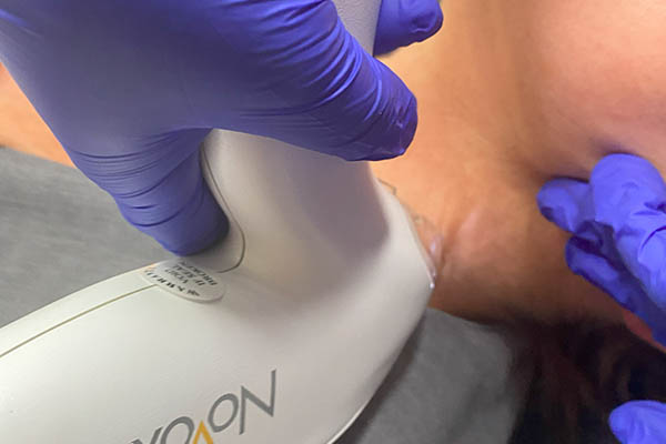 Tixel treatment performed on patient