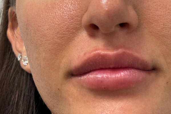 Lip filler in female patient