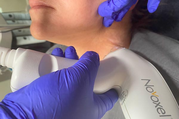Tixel treatment performed on patient's neck at FIBB