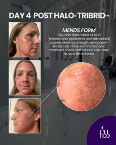 tribrid day 4