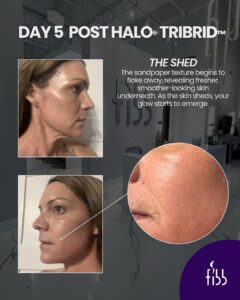 tribrid day 5